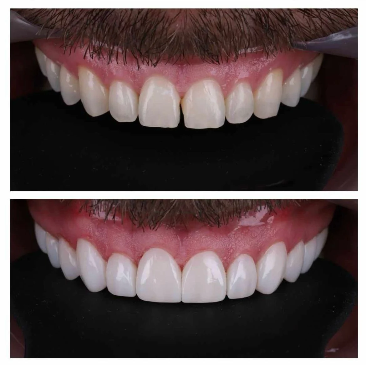 Facetas de porcelana