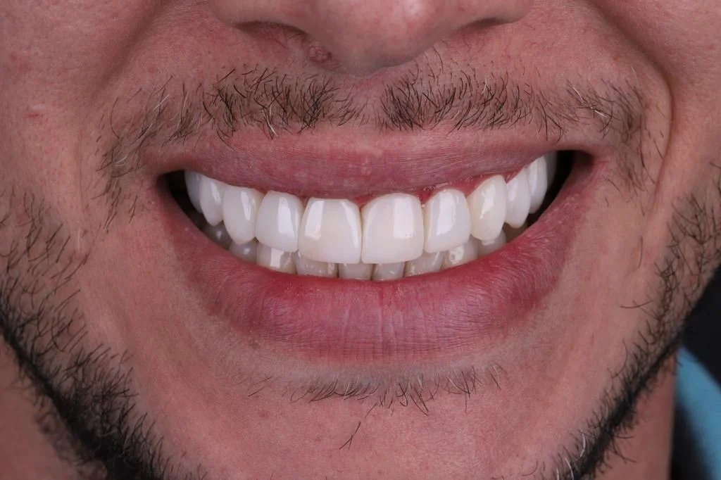 Implante dentário