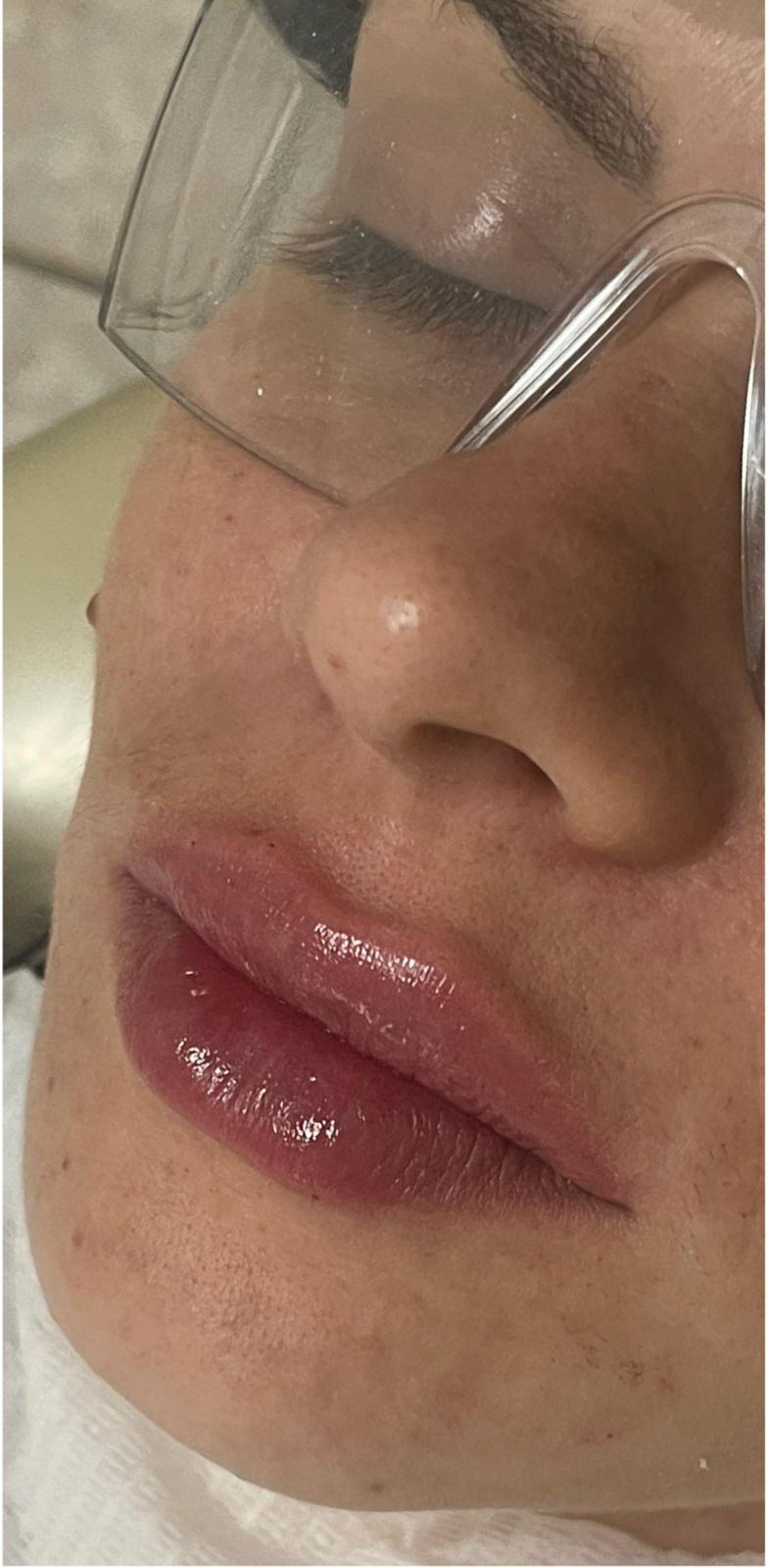 Tratamentos estéticos labial